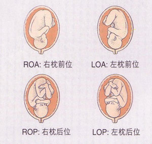 右骶后位胎儿图片图片