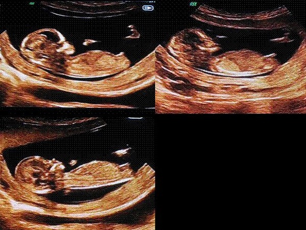 怀孕十二周男孩彩超图图片
