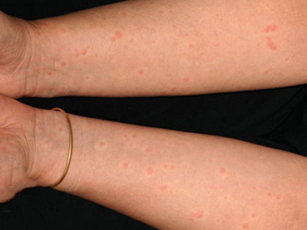 急性荨麻疹原因图片